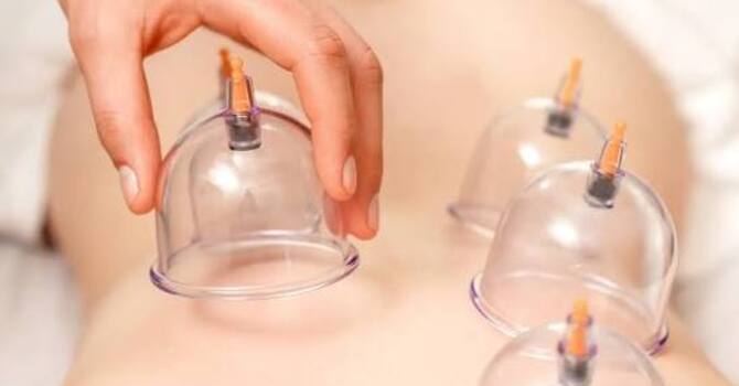 Cupping